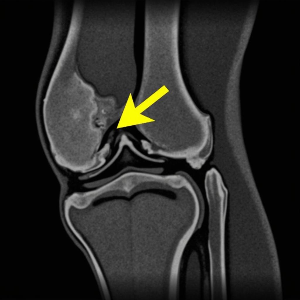 MRI Scan Showing PCL Tear